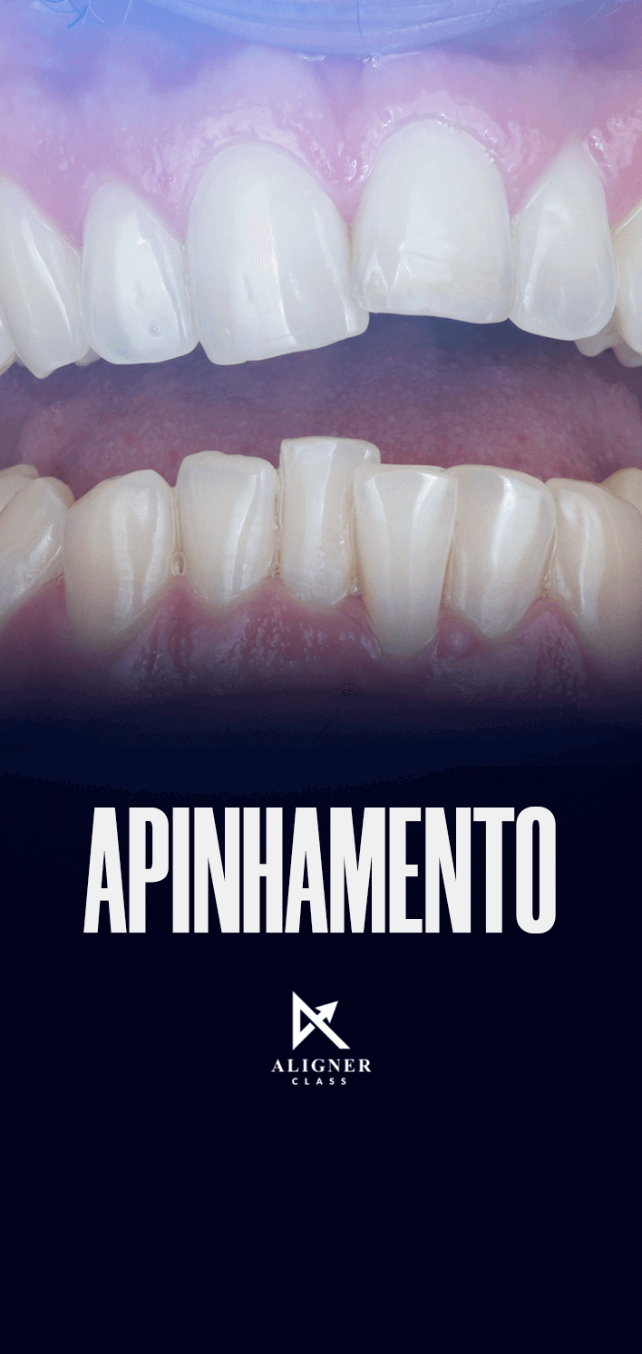 09 - Apinhamento - Vertical