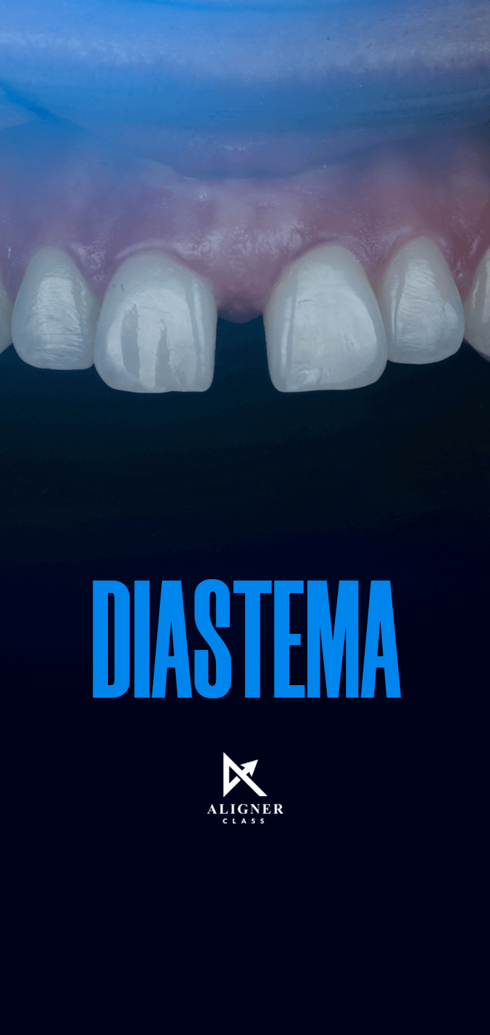 15 - Diastema - Vertical