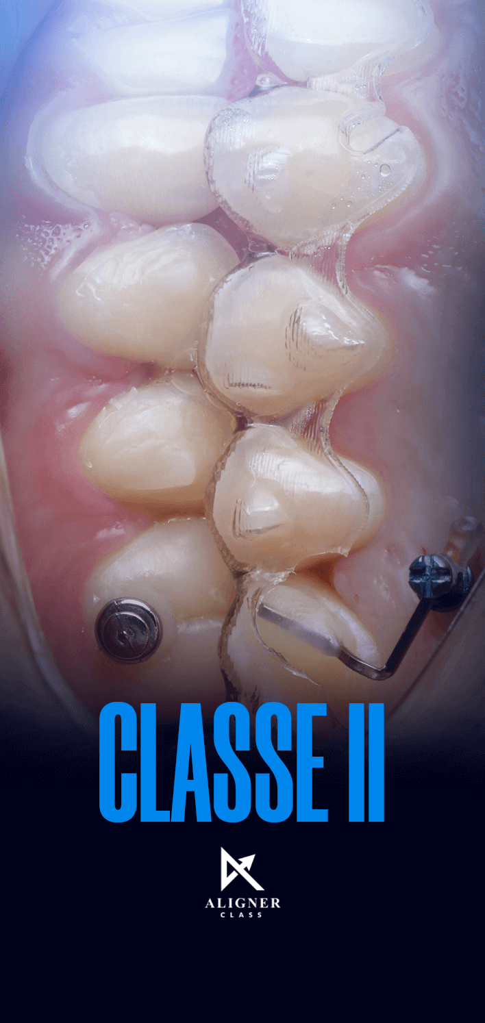16 - Classe II - Vertical